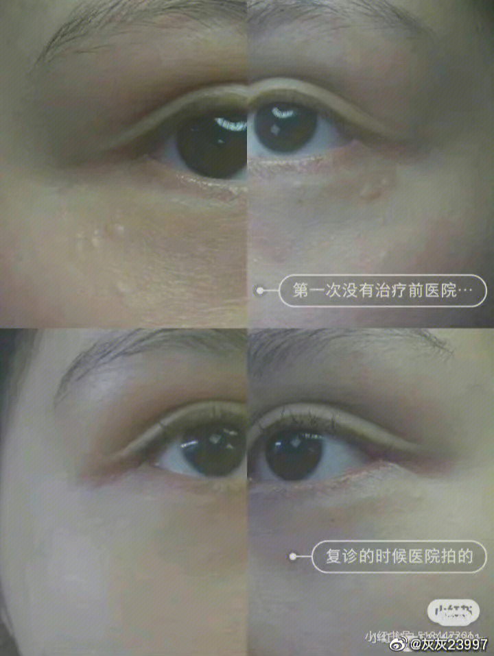 汗管瘤最新治疗方法详解