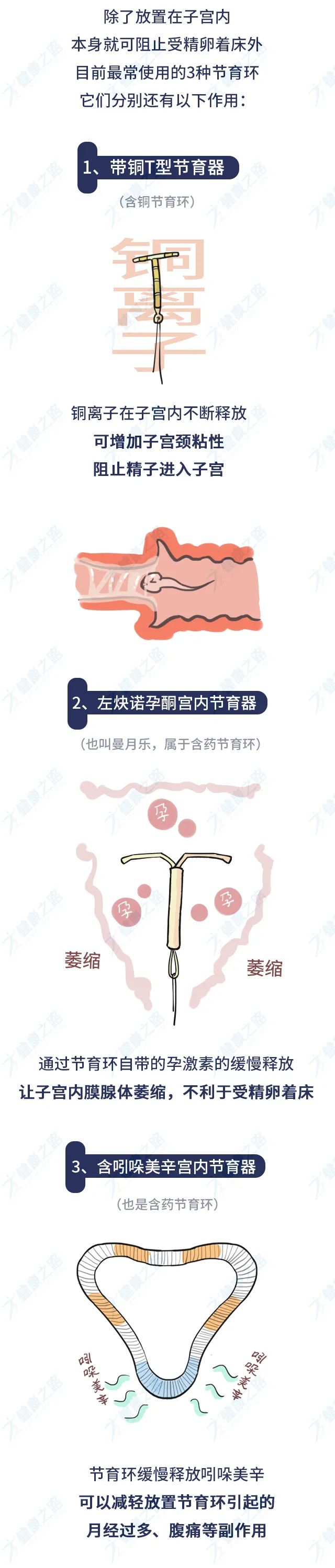 最新节育方式介绍