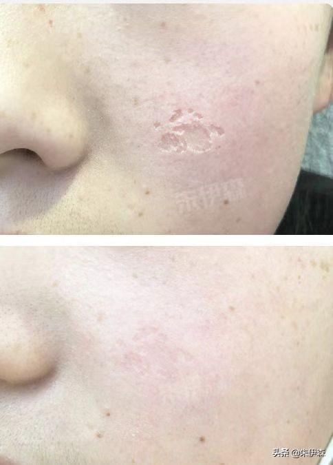 揭秘最新瘢痕治疗秘籍，治愈系福音助力瘢痕患者重塑信心✨